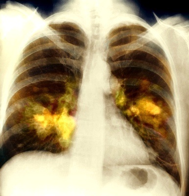 Interstitial Lung Disease