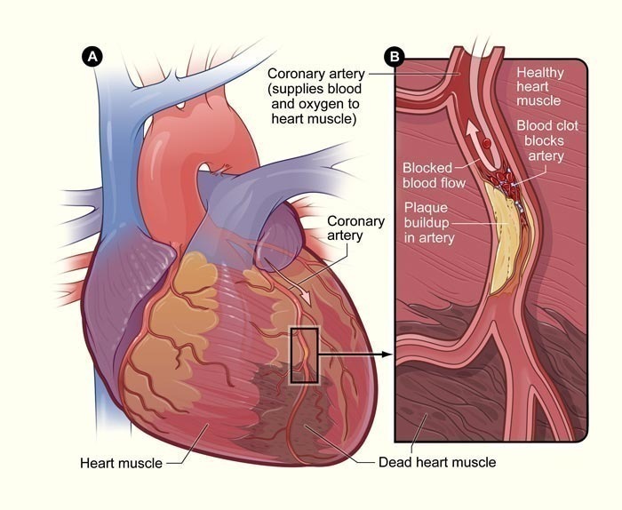 One challenge is that the heart disease symptoms in women can be different 