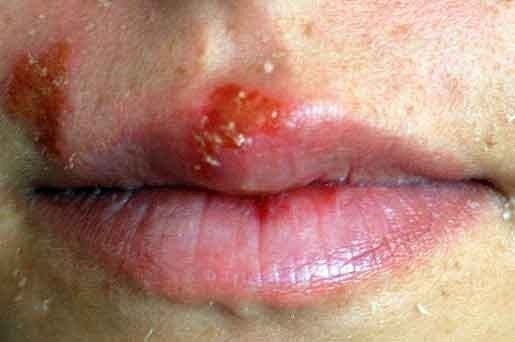 herpes symptoms in men pictures. and major herpes symptoms,