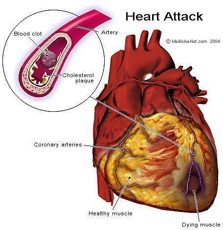 Although the symptoms are not as apparent as other heart diseases, 