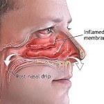remedies for viral sinusitis sinus issues smelling smoke