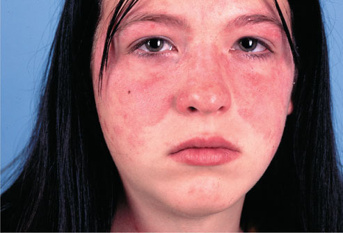 Download this Signs And Symptoms Lupus picture