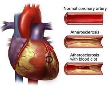 What is the hardening of the arteries, and what are the symptoms?