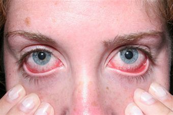 What is the treatment for blood in the eye?