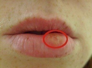 are cold sores still contagious after valtrex