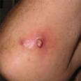 MRSA Pictures: MRSA Skin Infection Symptoms - WebMD