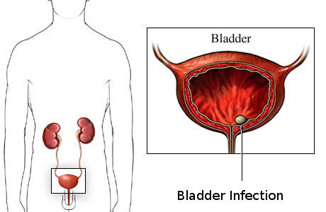 Bladder Infection Symptoms