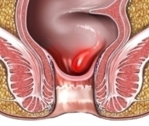 Hemorrhoid Symptoms