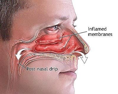 Sinus Infection Symptoms