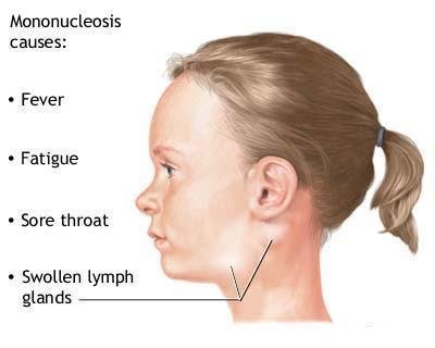 Mono Symptoms