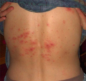 Shingles Symptoms