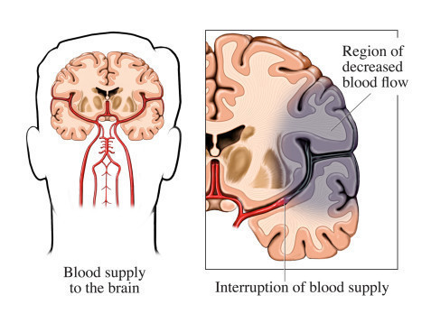 Enfermedad Cerebrovascular