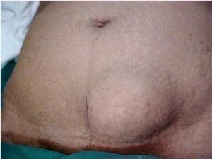 Abdominal Hernia Symptoms