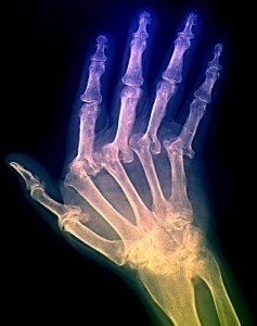 Arthritis Remedies