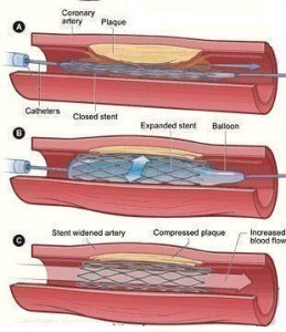 Blocked Arteries Symptoms