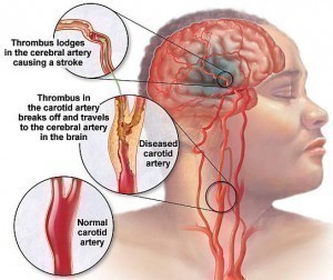 Symptoms of Blocked Carotid Artery