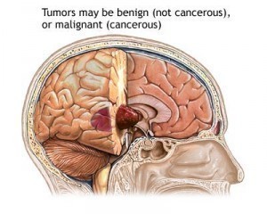 Brain Tumor Symptoms