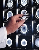 What Causes Brain Tumors?
