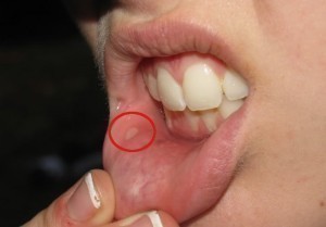 Canker Sore Remedy