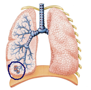 Chronic Obstructive Pulmonary Disease