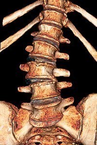 Degenerative Disc Disease