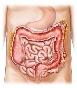 Diverticulitis Symptoms