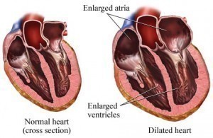 Enlarged Heart Symptoms