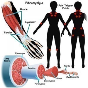 Fibromyalgia Symptoms