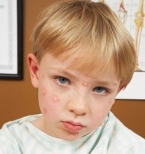 Fifth Disease