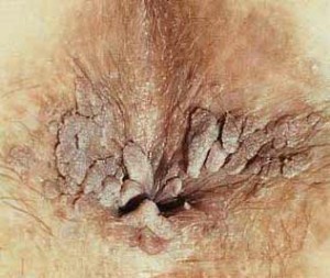 HPV Symptoms