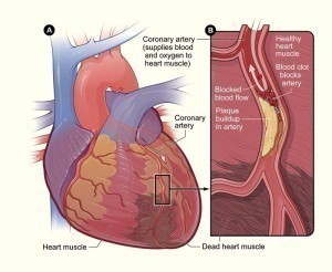 Heart Blockage Symptoms