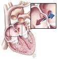 What Causes Heart Blockage?