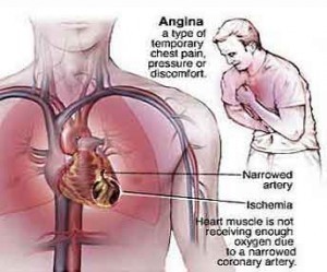 Heartburn Symptoms Vs Angina Symptoms