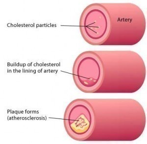 Symptoms of High Cholesterol