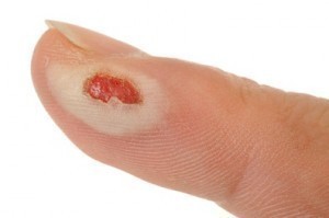 Home Remedies for Burns