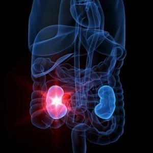 Kidney Failure Symptoms