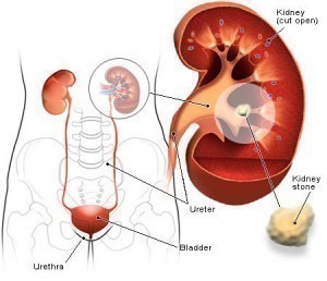 Kidney Stone Symptoms