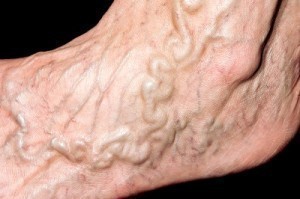 Laser Treatment for Spider Veins