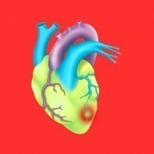 Mild Heart Attack Symptoms