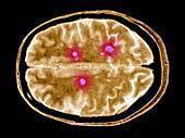 What Causes Multiple Sclerosis?