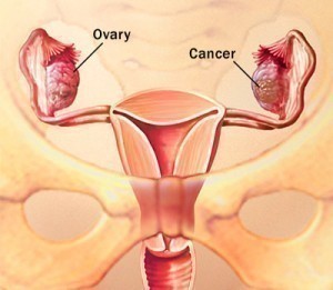 Ovarian Cancer Symptoms