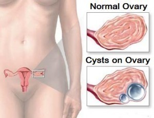 Ovarian Cyst Symptoms