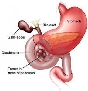 Pancreatic Cancer Symptoms