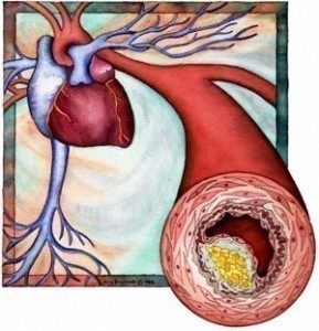 Peripheral Vascular Disease