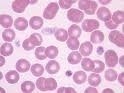 What Causes Low Platelets?