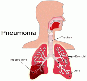 Pneumonia Symptoms