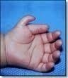 What Causes Polydactyly?