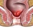 What Causes Rectal Bleeding?