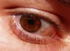 What Causes Red Eyes?