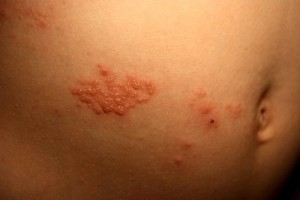 Remedies for Herpes